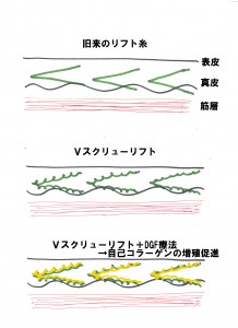 Ｖスクリューリフト